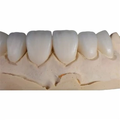 Vetro al disilicato di litio-Rivestimento in ceramica